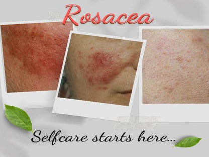 Organic Moisturizer for Rosacea Prone Skin - For Women & Men-2